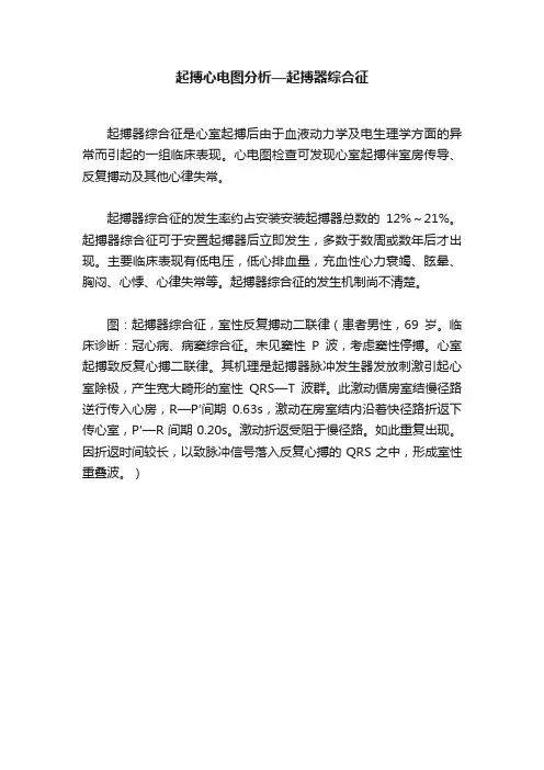 起搏心电图分析—起搏器综合征
