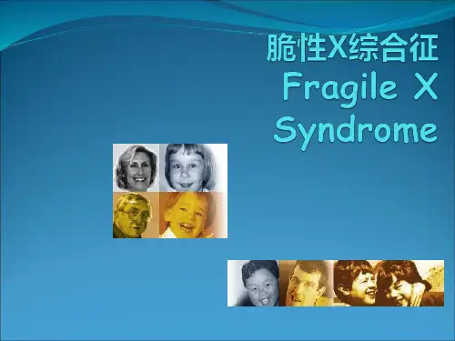 脆性X综合征