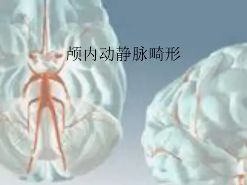 脑动静脉畸形(1)