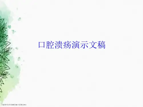 口腔溃疡演示文稿