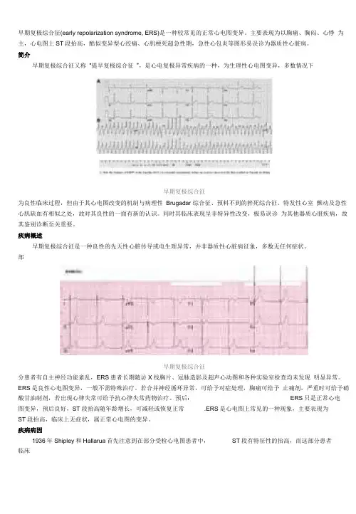 早期复极综合症