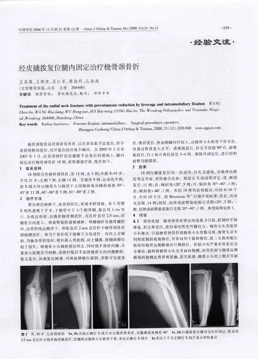 经皮撬拨复位髓内固定治疗桡骨颈骨折
