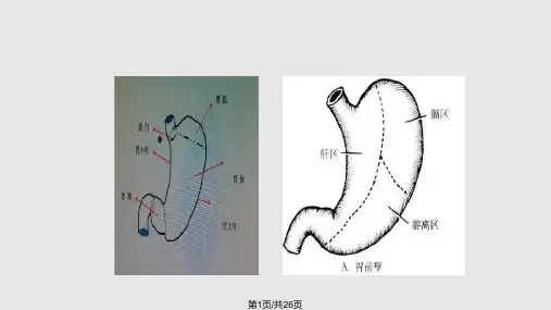 胃大部分切除术手术配合PPT课件