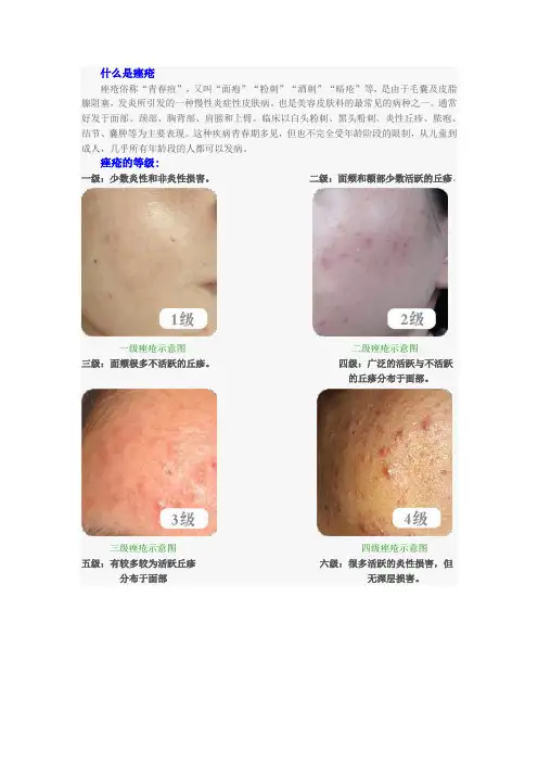 什么是痤疮_痤疮等级区分