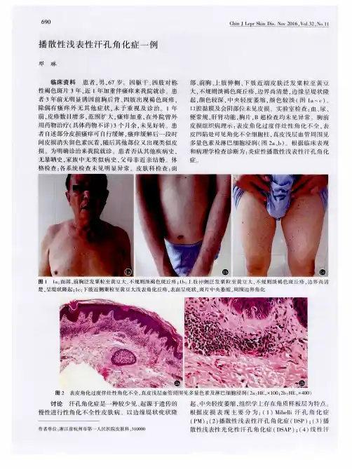 播散性浅表性汗孔角化症一例