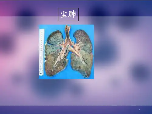 尘肺影像表现  ppt课件