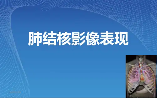 【影像诊断课件】肺结核影像表现(示教片)