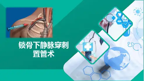 锁骨下静脉穿刺置管术